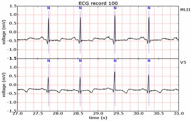 ecg